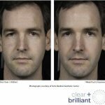 Лазерное омоложение лица: преимущества, побочные эффекты, отзывы миниатюра