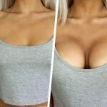 Увеличение груди — маммопластика миниатюра