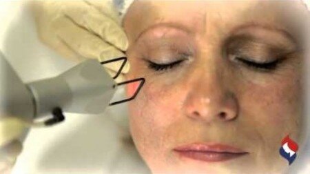 подтяжка лица без операции лазерная 