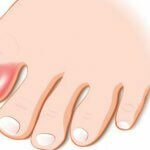 Причины и методы лечения вросшего ногтя миниатюра