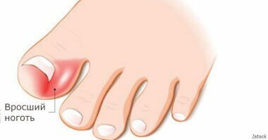 Причины и методы лечения вросшего ногтя
