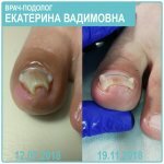Виды лечения вросшего ногтя миниатюра