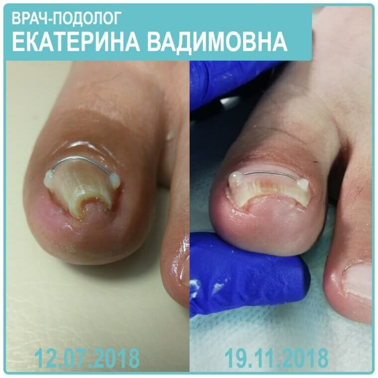 Виды лечения вросшего ногтя